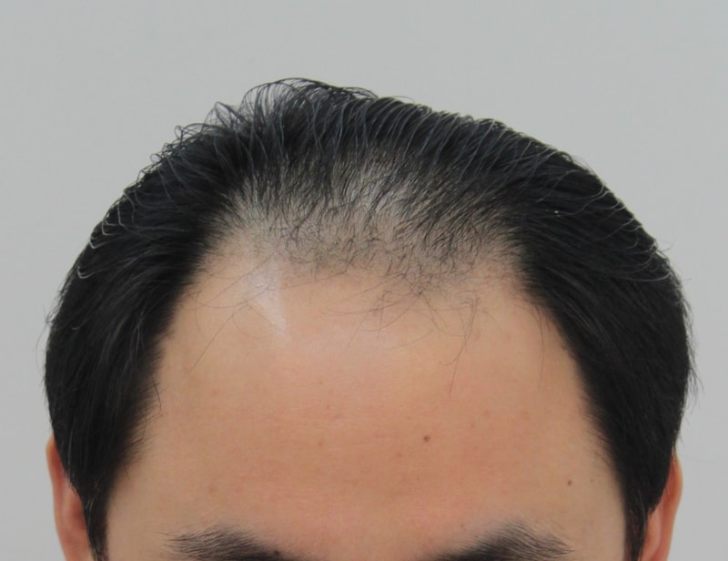 It's been 10 months since my hair transplant was 1600