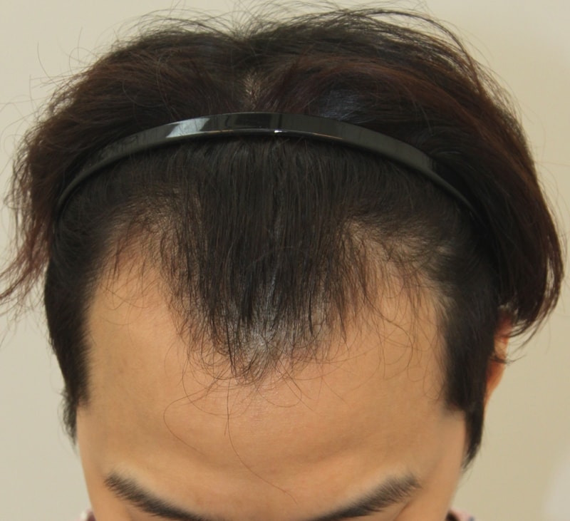 포헤어 한달 차 긴 레이스의 시작