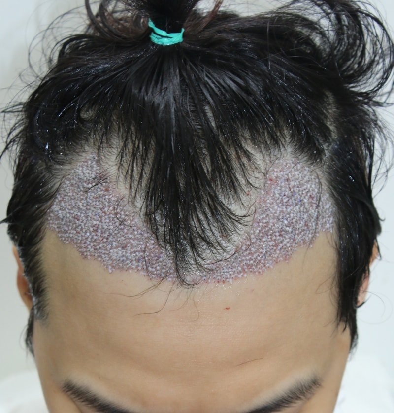 수술후1.JPG