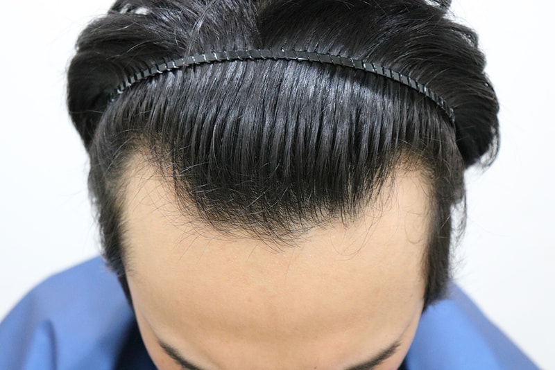 The hair transplant is finally over after a year ^^