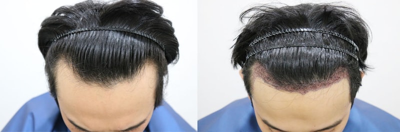 3,200-mo non-intersected hidden-cut hair transplant surgery review