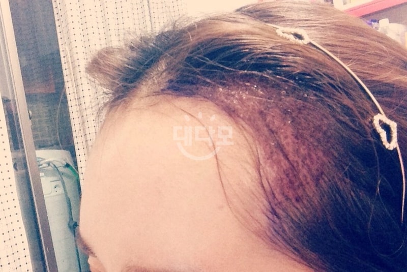 헤어라인교정 8개월 보름쯤 되었어요~