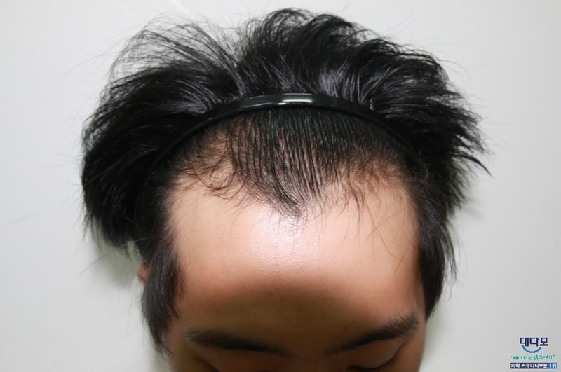 It's been 7 months since I had a hair transplant, and I have a question! (Added a correction photo)