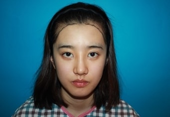 수술전.jpg