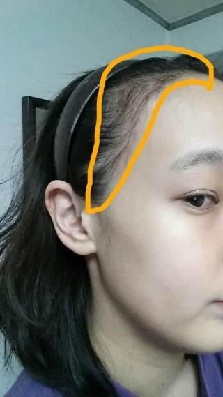 헤어라인2달.JPG