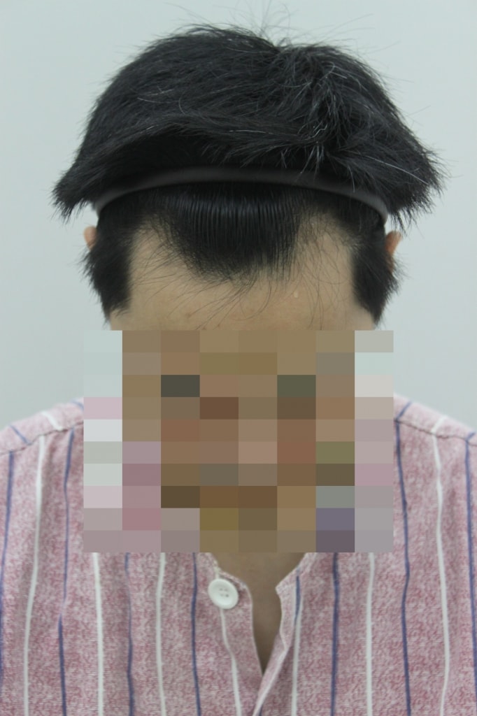 2년간 고민한 무삭발 비절개 C2G 1200모낭 후기