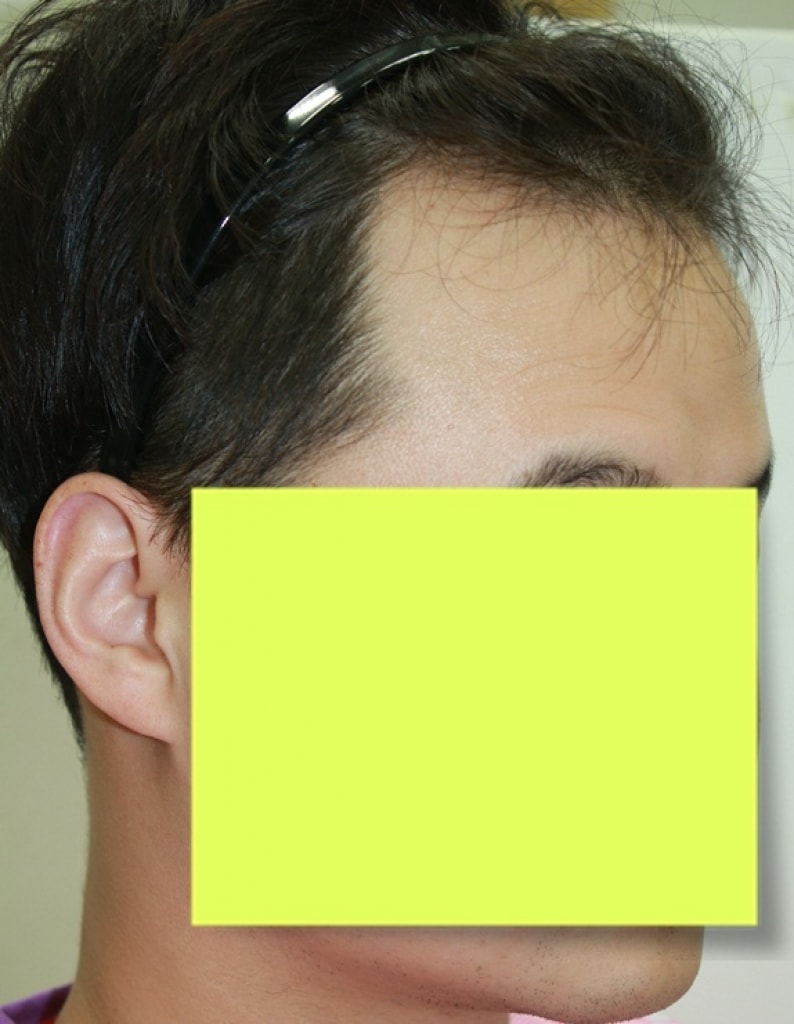 Review of Non-Cutting Shave 1100 Hair follicle Surgery