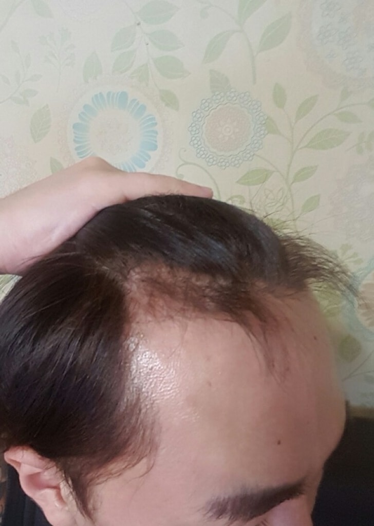 Following the review of hair loss transplantation in M shape, I brought it again