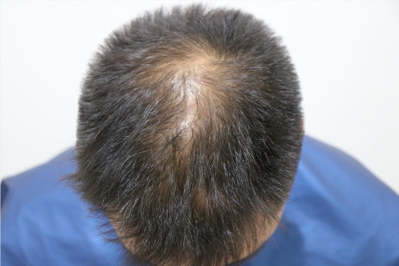 It's been two weeks since I had an 800-mo top transplant