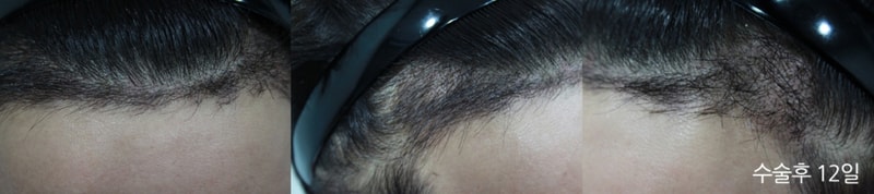 A month after New Hair Surgery