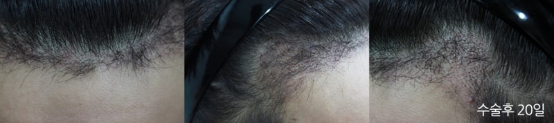 New hair transplant over 50 days