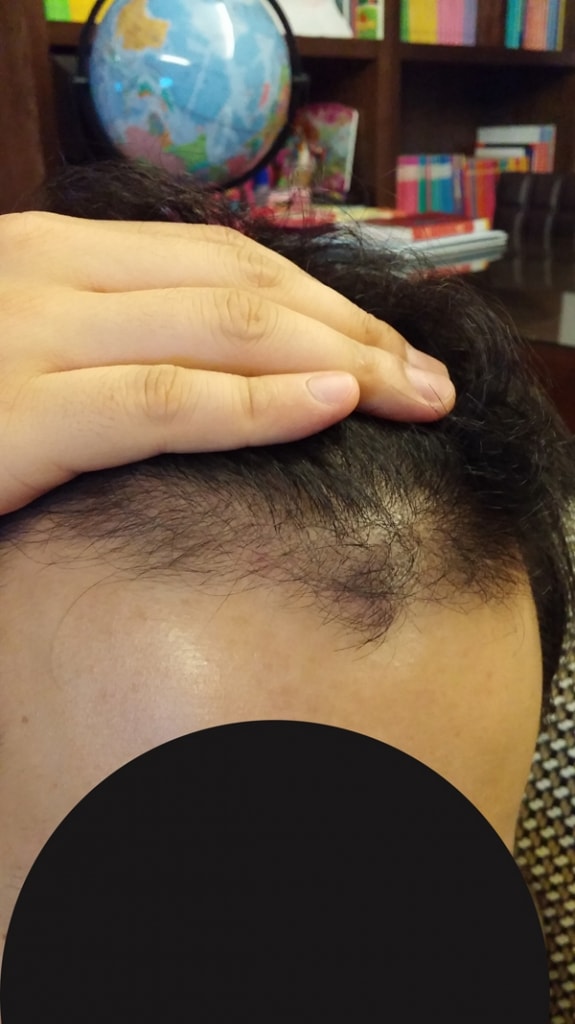 이식모가 빠지고 자라기를 반복 중...