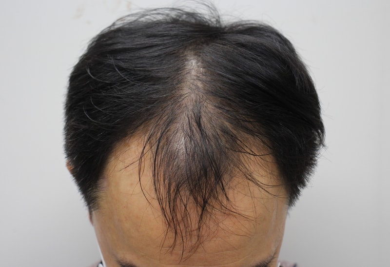 I gave my father's hair transplant to Jang Sung-ho in Daegu