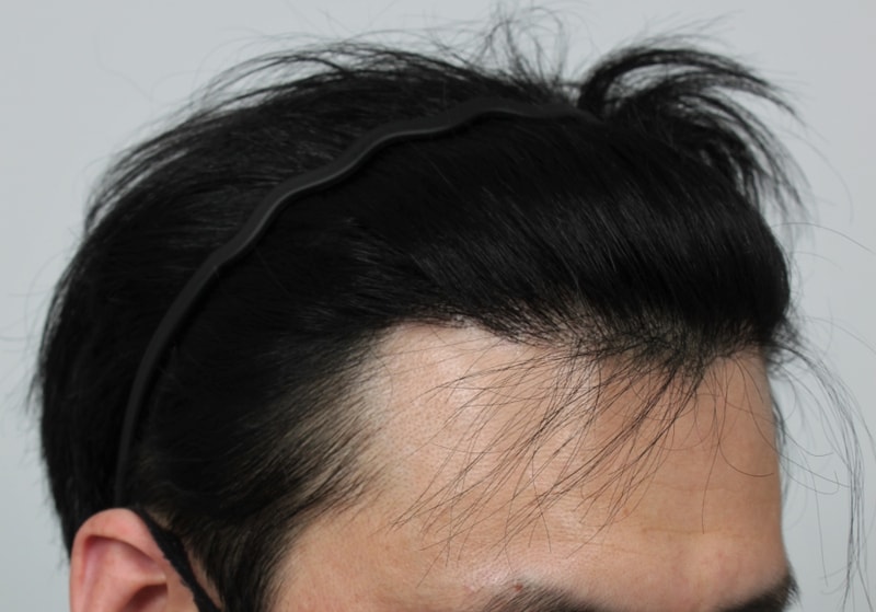 5.수술후.JPG
