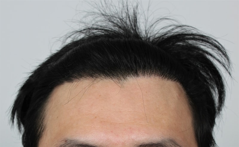 2.수술후.JPG