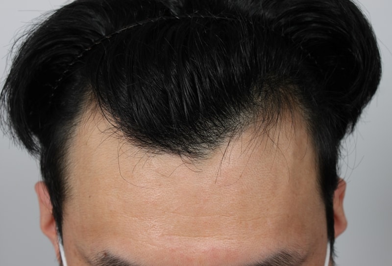 1.수술전.JPG