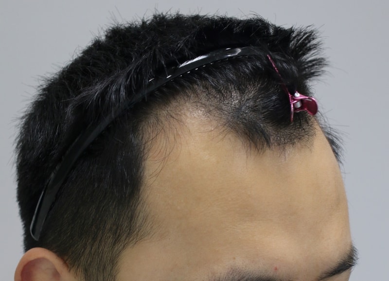 2.수술전.JPG