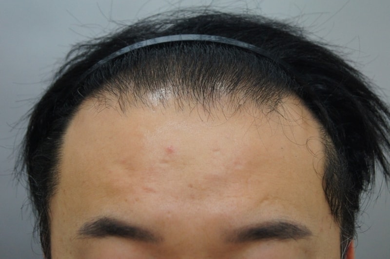 2차이식삭발전.1.JPG
