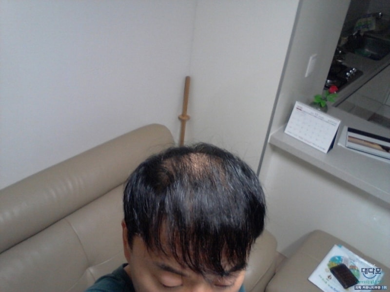 2014년(2차이식전.3).jpg