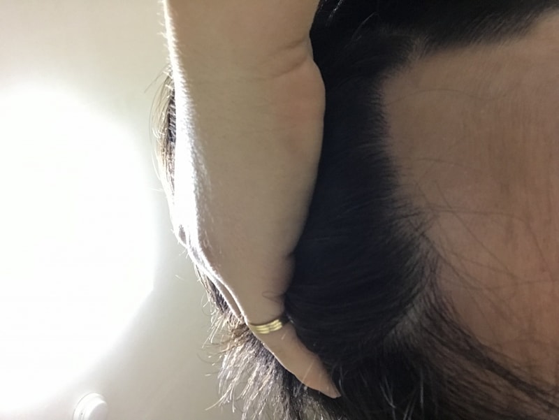 毛髪移植8ヶ月目です！