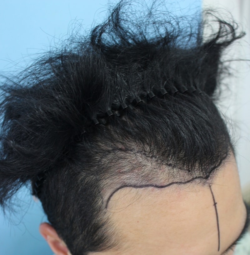 [Hannive Hair Transplantation Center] Cut-out M-shaped 2,500 Mo 4 months review