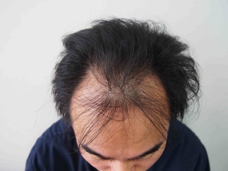 5000모 이식받은지 한달 됬습니다,,,