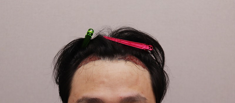 수술 후.JPG