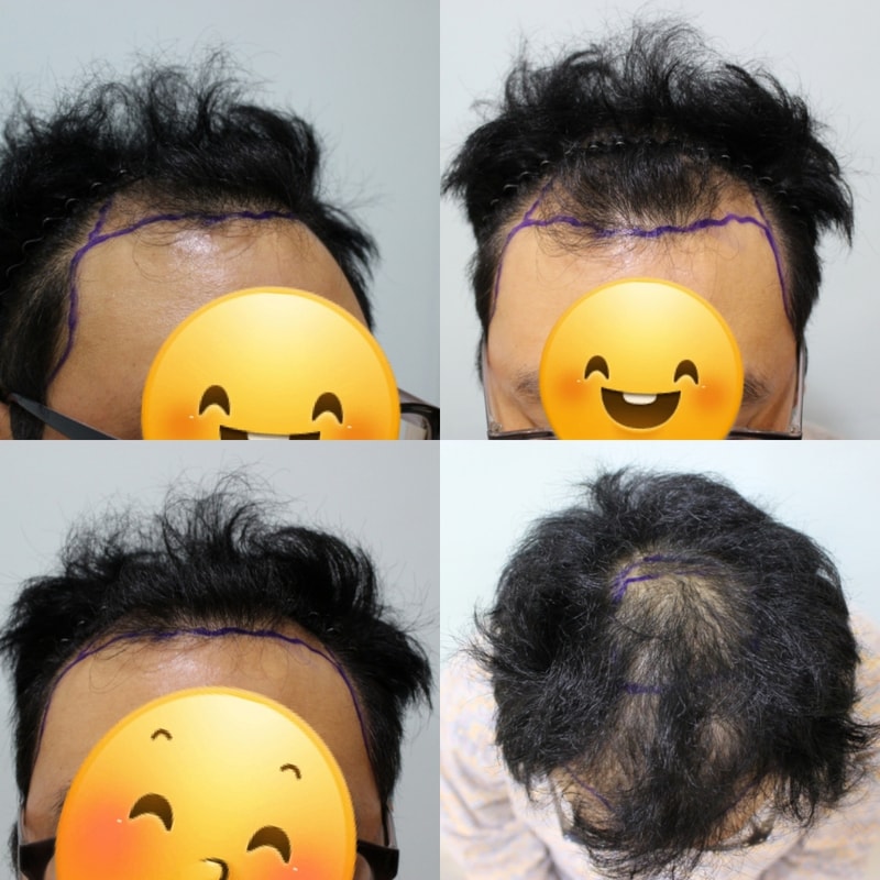 수술전.jpg