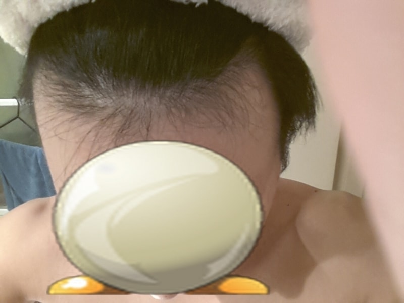 2700本の毛切開で移植後2週間しても3日経過後です。