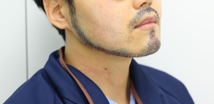 狎鴎亭 マンモスヘアライン 医院 毛髪移植 (あご、鼻の下) 4ヶ月経過後のレビュー