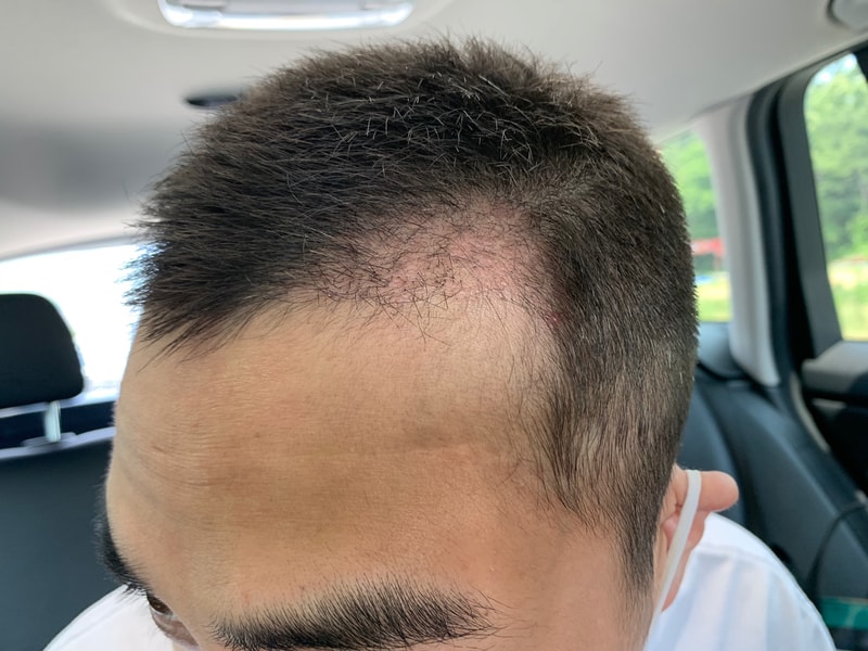 It's amazing that it's been 2 months since I had my forehair.