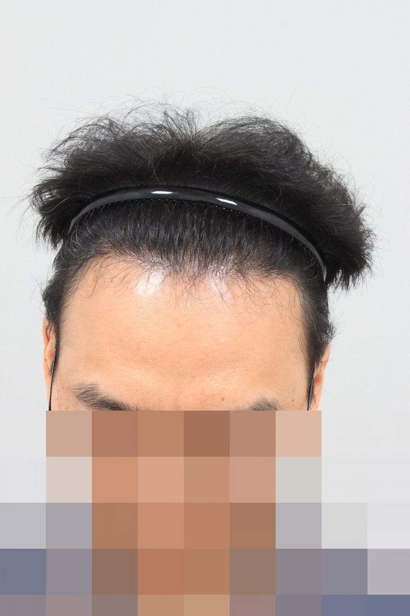 수술후 1.JPG