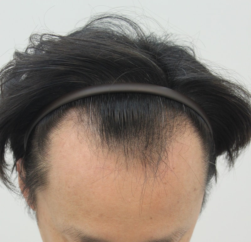 수술전 2.JPG