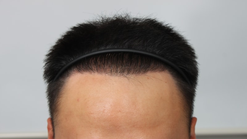 수술후 2.JPG