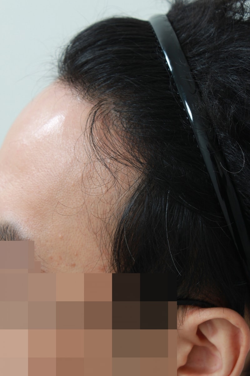 수술후 5.JPG