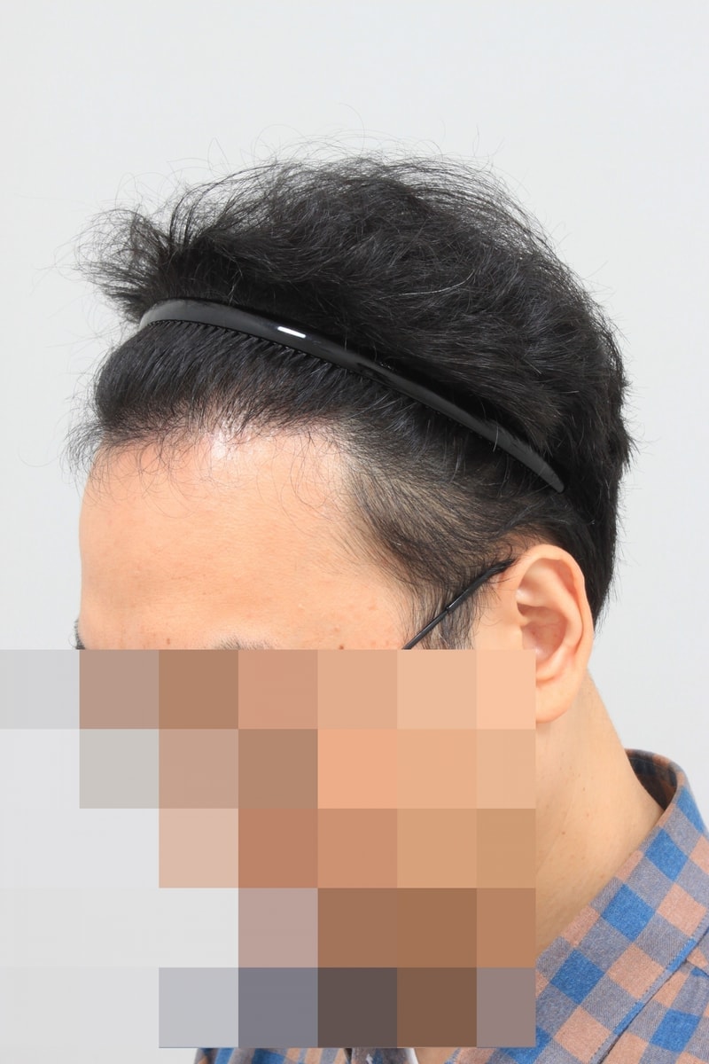 수술후 2.JPG