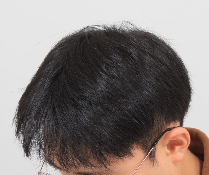 수술10개월2.JPG