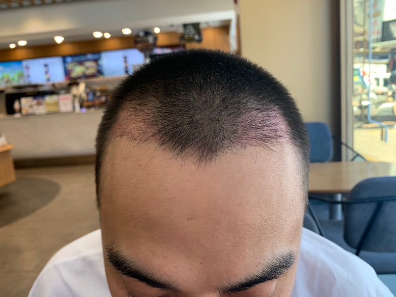 Dark Age in Week 3 of Forehead + Management Review