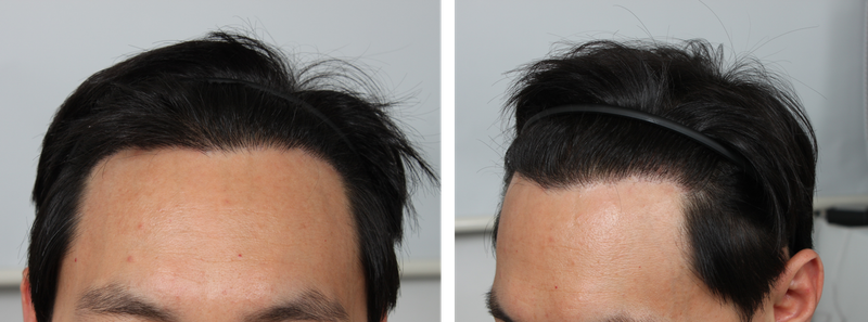 10-month hair transplant overcoming M-shaped hair loss