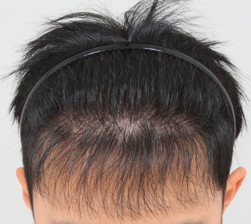 수술7개월.JPG