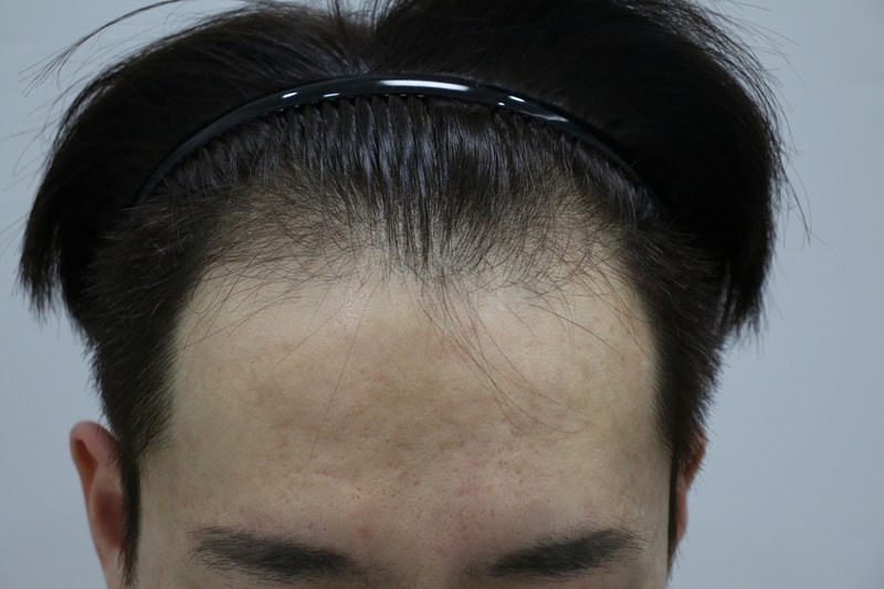 수술부터 ~ 5개월까지 포헤어 후기
