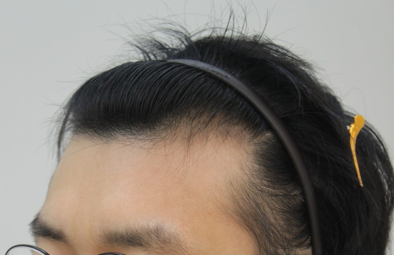 수술전 1.JPG