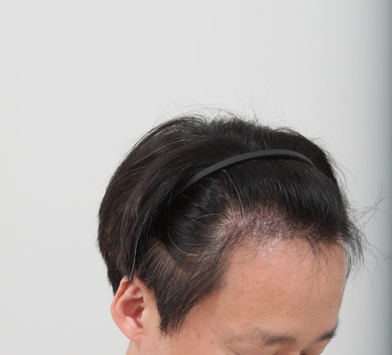 포헤어수술후기 밀도어떤가요? 7개월 경과