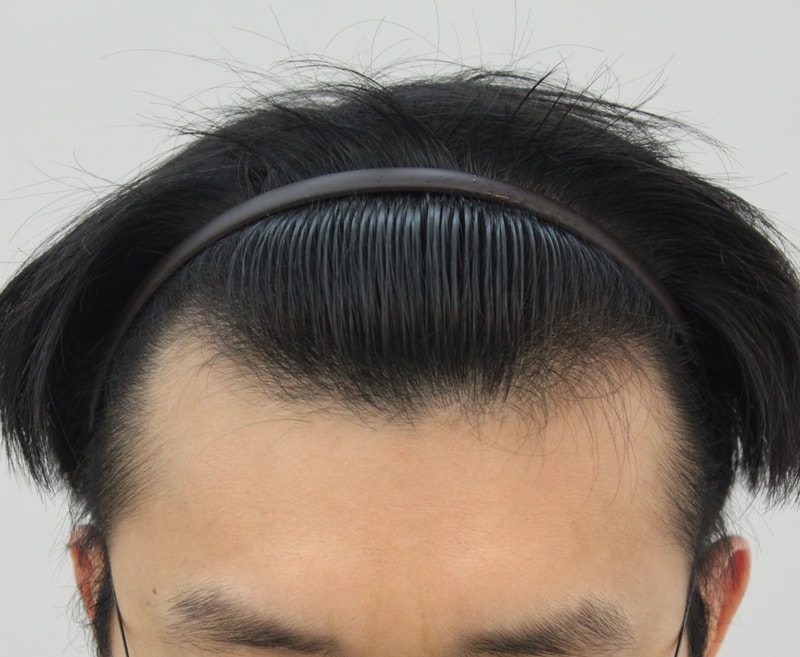 수술전 2.JPG