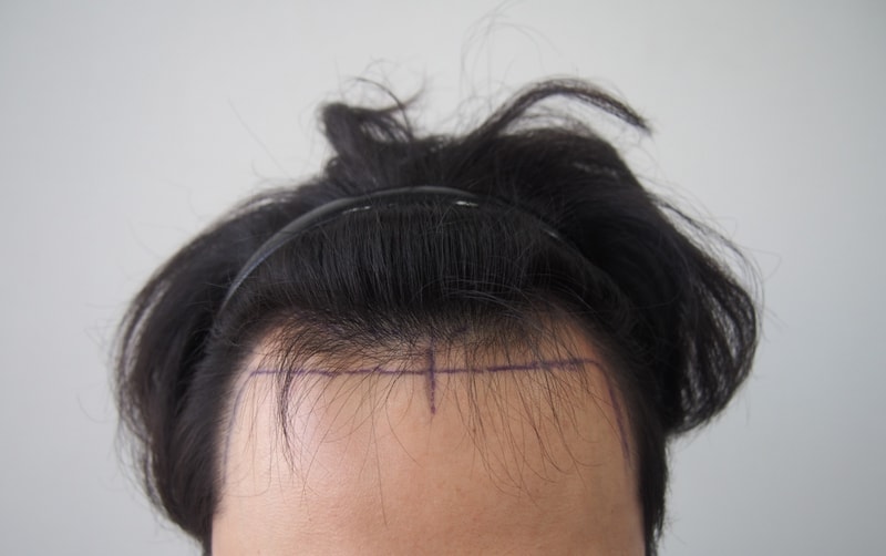 Pre-operative, immediate photos