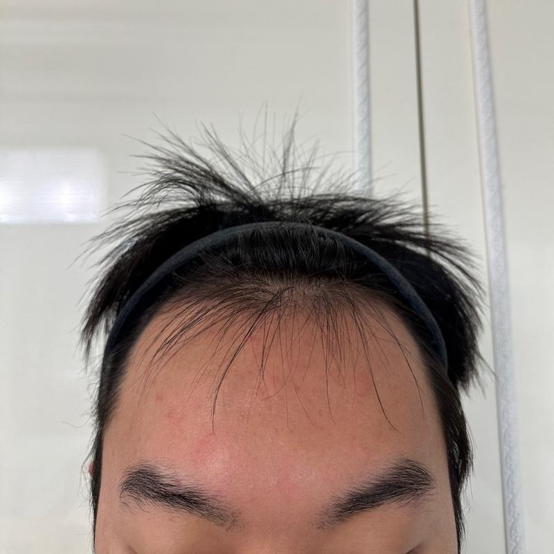 디에이성형외과 모발이식 비절개 투블럭 4000모 1년차 입니다.