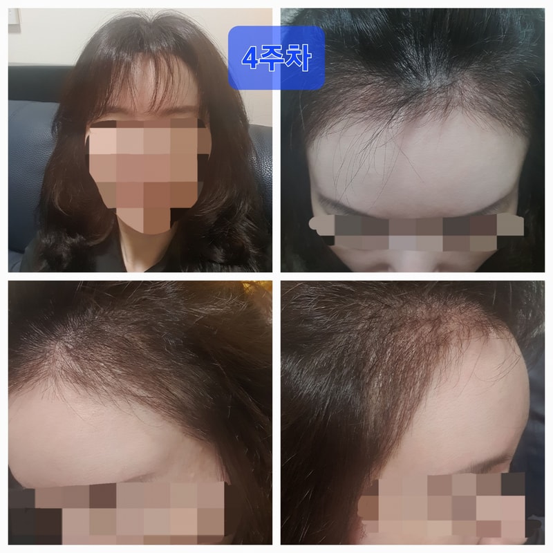 Women's hairline transplant in the dark for the 6th week