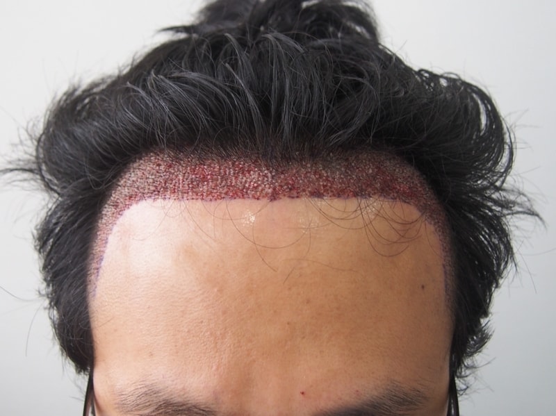 I'm five months into surgery