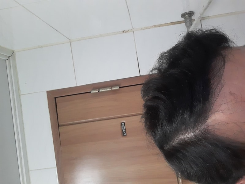 2次ヘアライン2800毛1年レビュー
