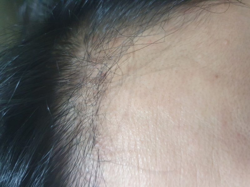 ヘアライン手術後4ヶ月目のレビュー
